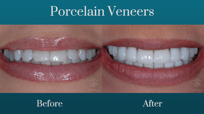 Before and after smile of porc